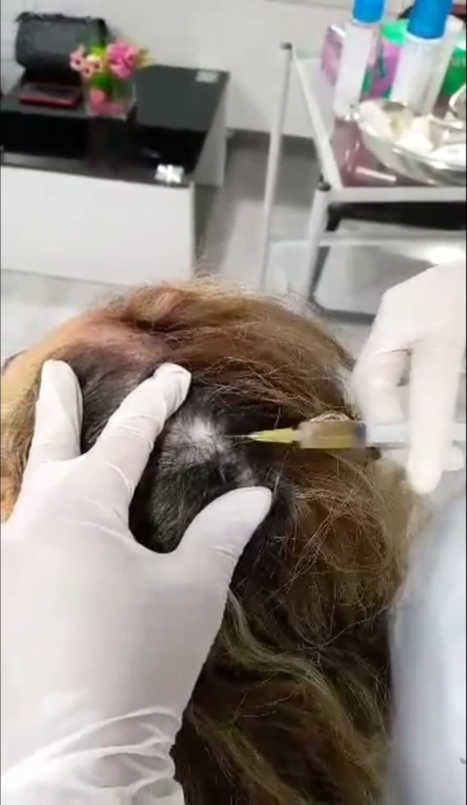 Injection au cuir chevelu